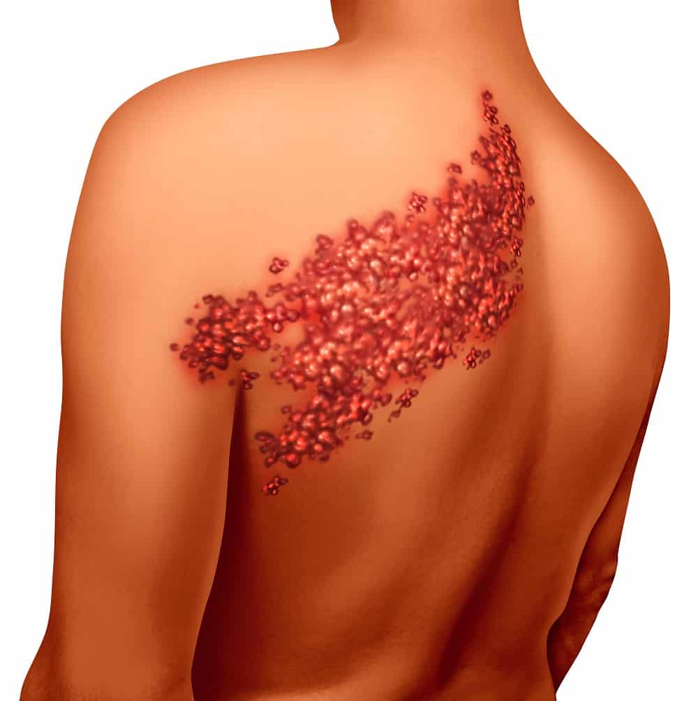 صورة توضيحية لطفح الحزام الناري على الكتف والظهر، يظهر على هيئة تجمع من البثور الحمراء على جانب واحد من الجسم