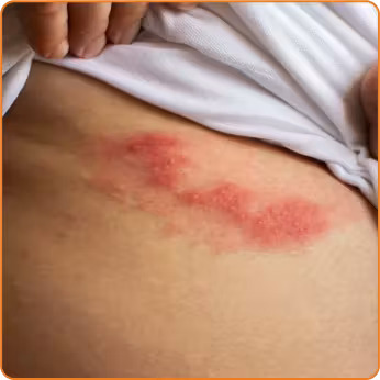 صورة توضيحية لطفح الحزام الناري على منطقة البطن، يظهر على هيئة شريط من البثور المؤلمة على جانب واحد من الجذع